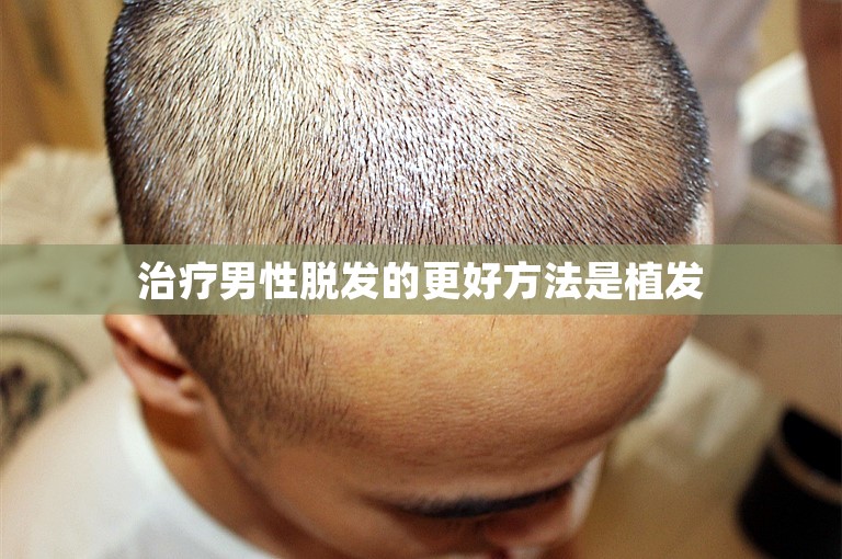 治疗男性脱发的更好方法是植发