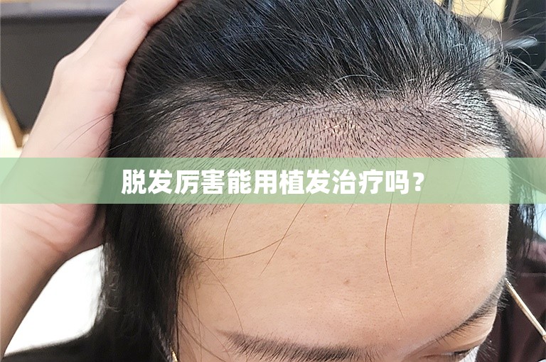 脱发厉害能用植发治疗吗？