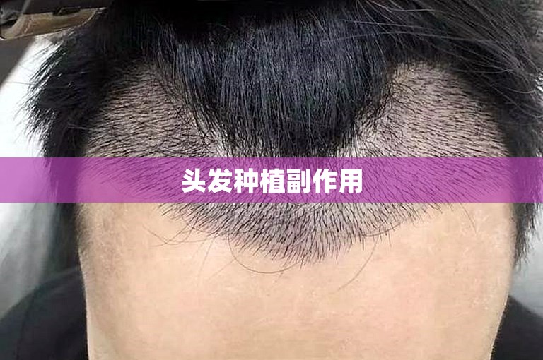 头发种植副作用