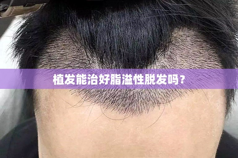 植发能治好脂溢性脱发吗？