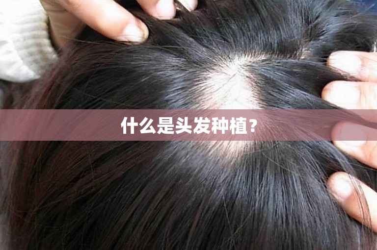 什么是头发种植？