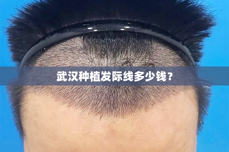 武汉种植发际线多少钱？