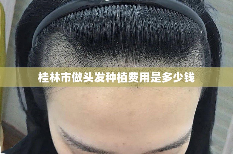 桂林市做头发种植费用是多少钱