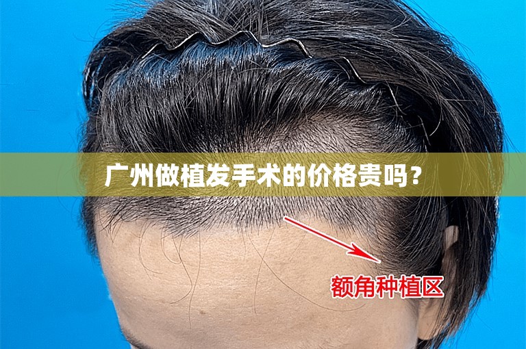 广州做植发手术的价格贵吗？