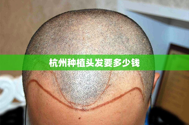 杭州种植头发要多少钱