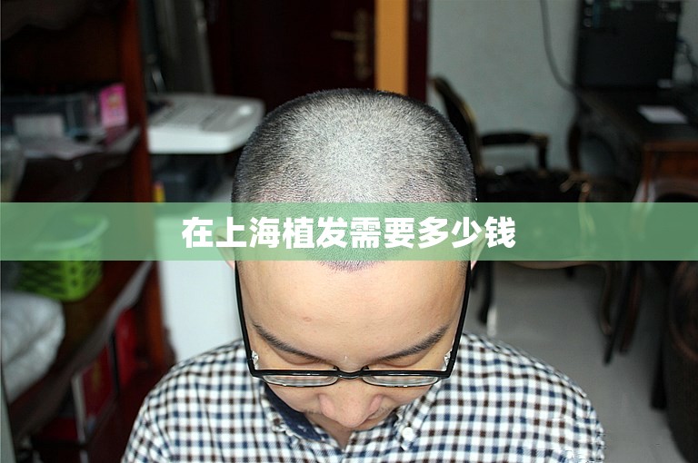 在上海植发需要多少钱