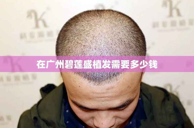 在广州碧莲盛植发需要多少钱