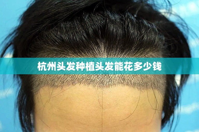 杭州头发种植头发能花多少钱