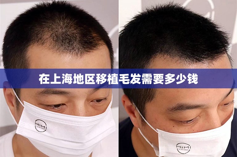 在上海地区移植毛发需要多少钱