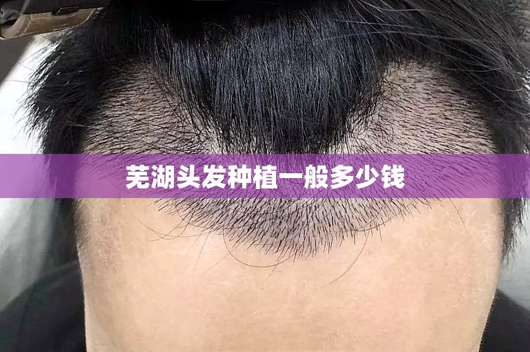 芜湖头发种植一般多少钱