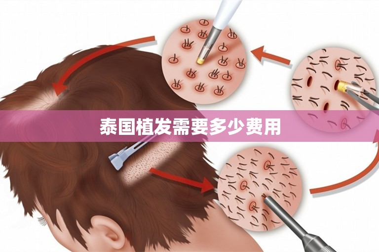 泰国植发需要多少费用