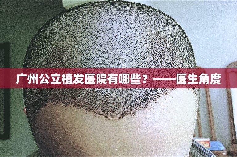 广州公立植发医院有哪些？——医生角度