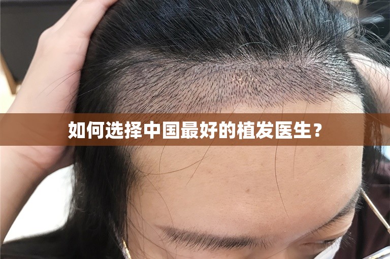 如何选择中国最好的植发医生？
