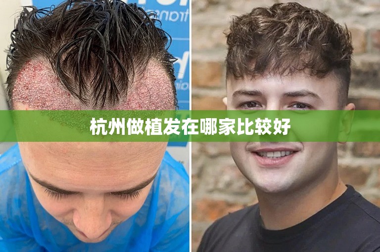 杭州做植发在哪家比较好