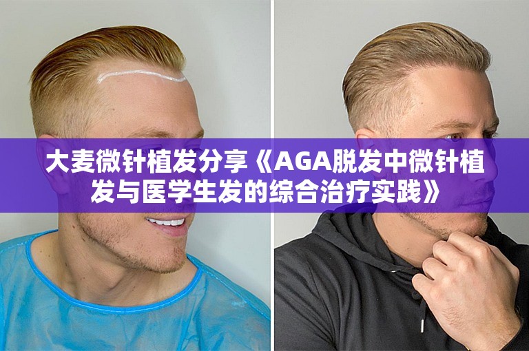 大麦微针植发分享《AGA脱发中微针植发与医学生发的综合治疗实践》