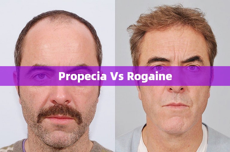 Propecia Vs Rogaine