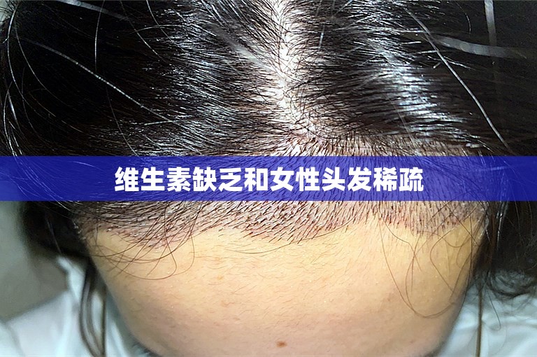 维生素缺乏和女性头发稀疏