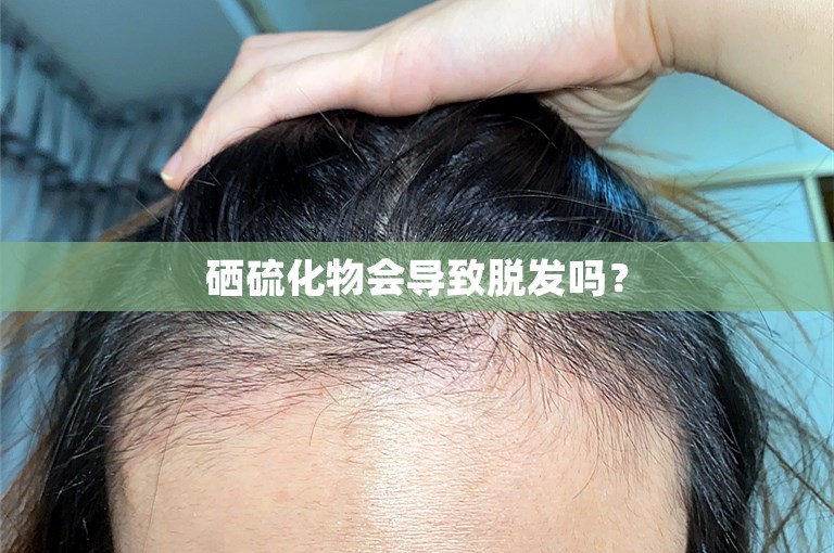 硒硫化物会导致脱发吗？