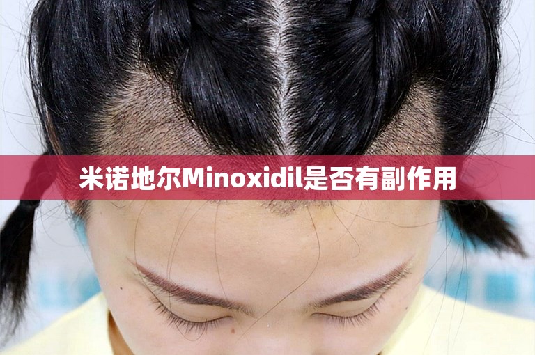 米诺地尔Minoxidil是否有副作用