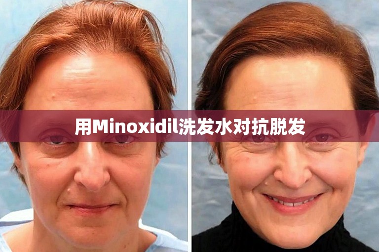 用Minoxidil洗发水对抗脱发