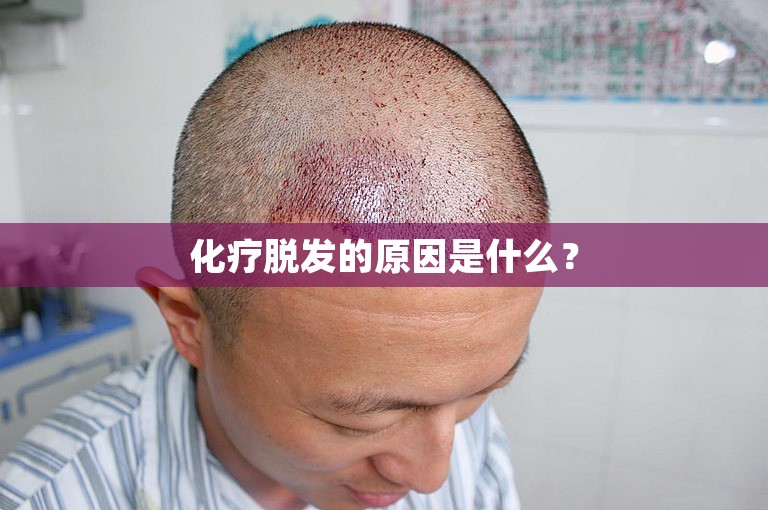 化疗脱发的原因是什么？