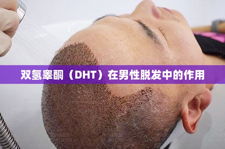 双氢睾酮（DHT）在男性脱发中的作用