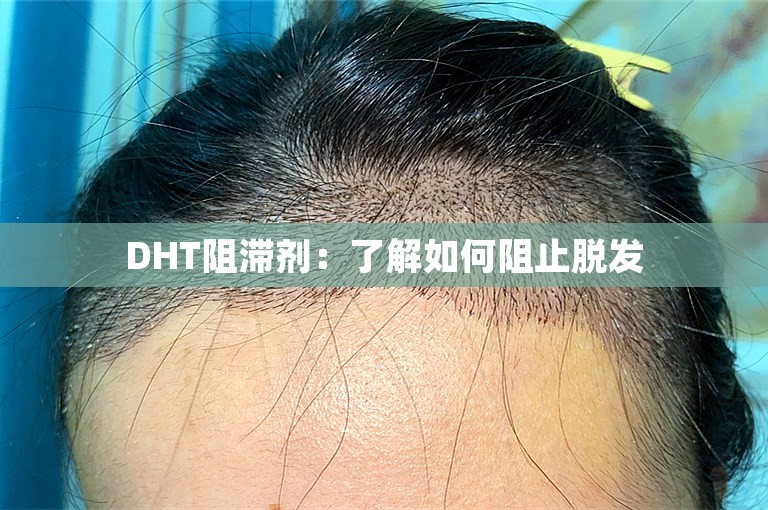 DHT阻滞剂：了解如何阻止脱发