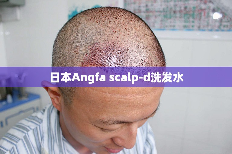 日本Angfa scalp-d洗发水