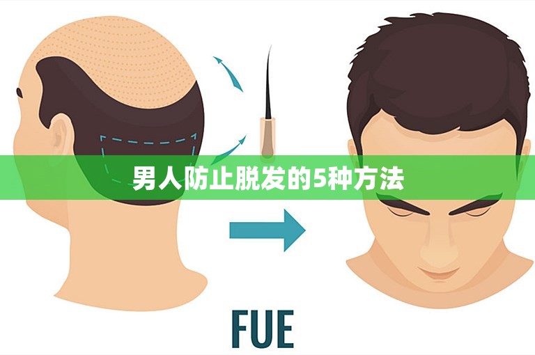 男人防止脱发的5种方法