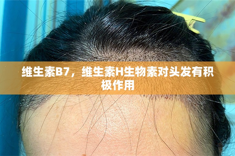 维生素B7，维生素H生物素对头发有积极作用
