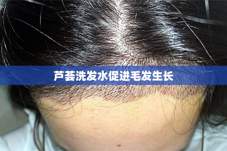 芦荟洗发水促进毛发生长