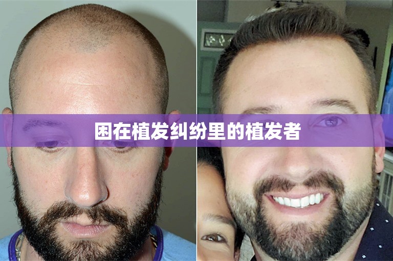 开拓药业-B(09939.HK)：KX-826治疗男性脱发中国III期临床试验结果