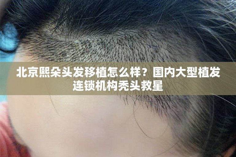 北京熙朵头发移植怎么样？国内大型植发连锁机构秃头救星