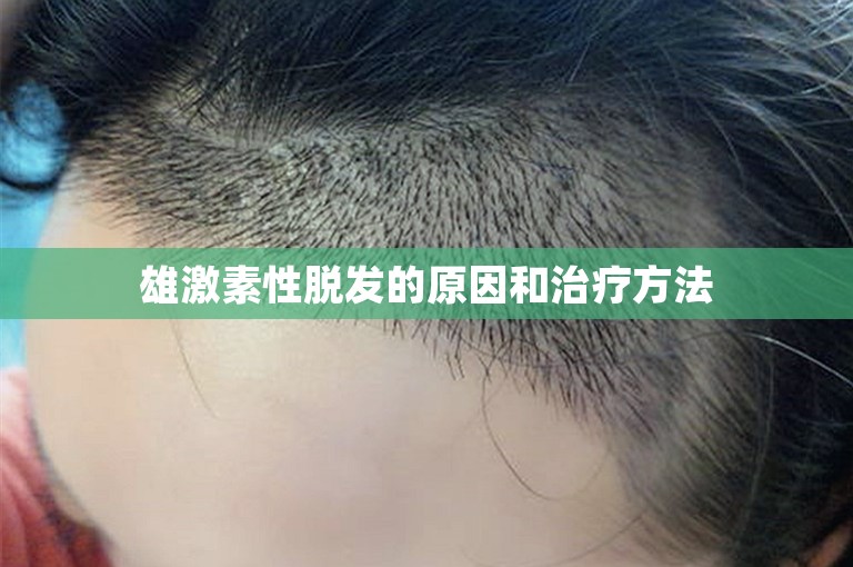 雄激素性脱发的原因和治疗方法
