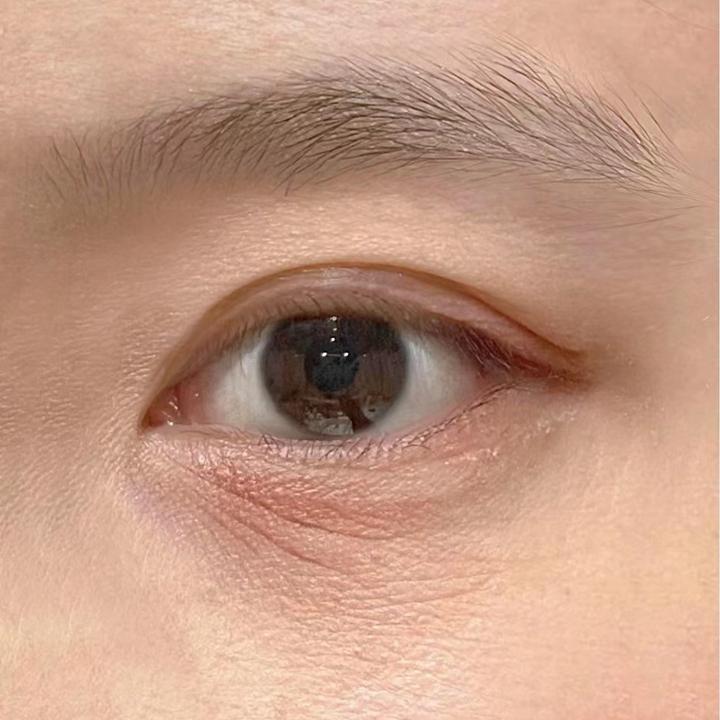 从医学角度看，眼周皱纹特别多，怎么安全高效地改善它？