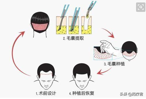 植发一个月后，他后悔了，植发到底“值不值”？这笔账你要会算