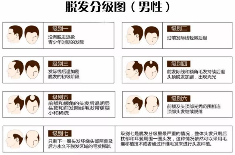 脱发科普：5种常见脱发类型及男女脱发区别，今天一次性讲清楚