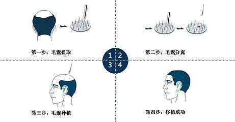 每6个人中1人脱发 植发市场发展迅速 3D植发技术备受业内关注