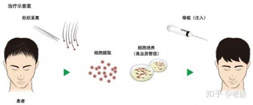 日本的“毛囊干细胞”技术，现在怎样了？