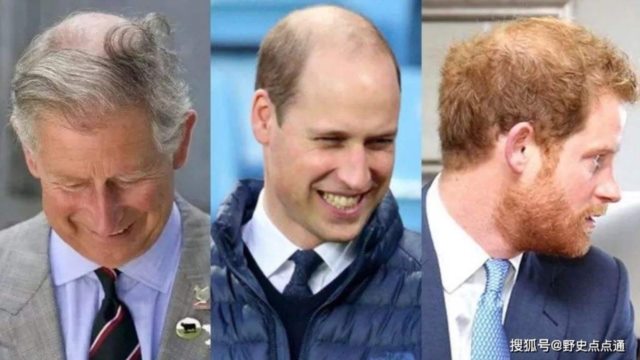 查尔斯、威廉、哈里都秃了英国皇室为何躲不开秃顶魔咒？