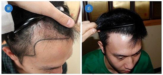 新生植发医院治疗男性脱发效果怎么样