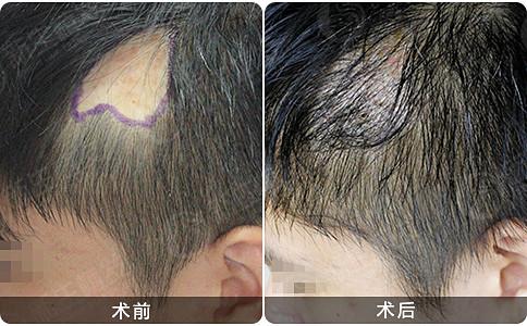 南京新生植发医院头发种植效果