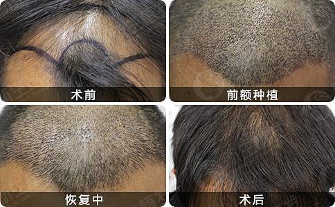 植发医院治疗患者脱发的方法有哪些