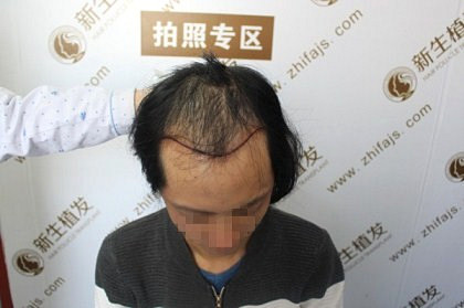 杭州新生植发医院植发效果如何，植发患者告诉你