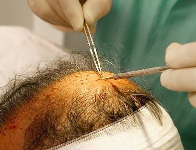 植发手术是由一个医生来进行的吗