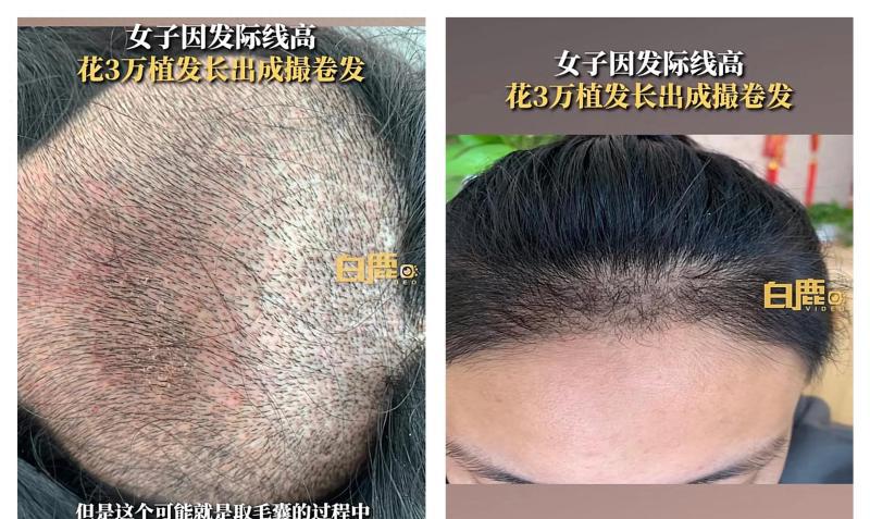 北京一女子花3万植发，长出成撮卷毛 网友调侃：这是来自腋窝吗