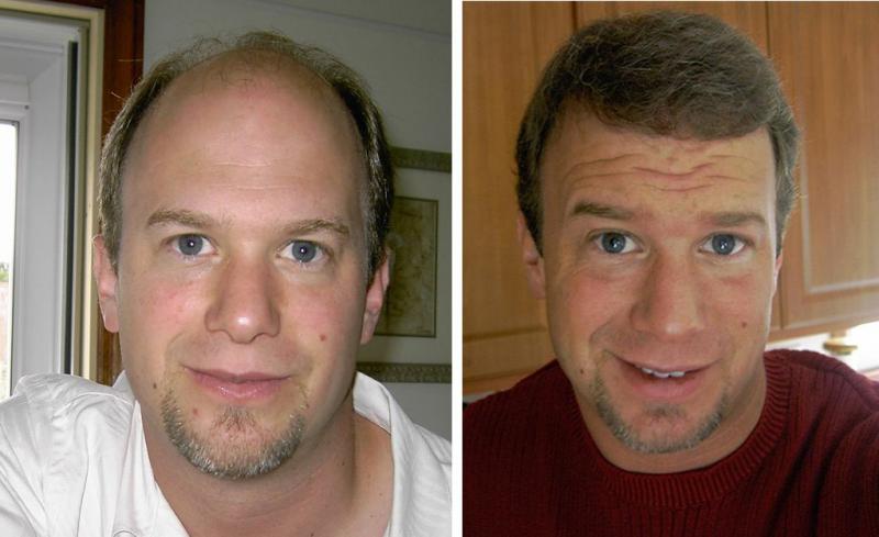 男性移植头发效果