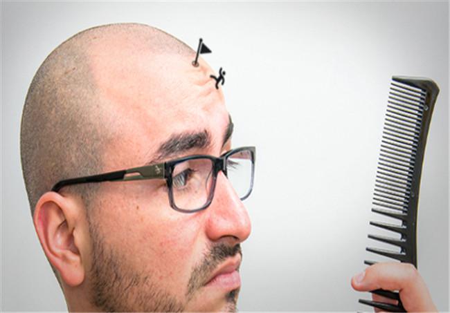 男性早秃能植发么？3个问题帮你搞清楚