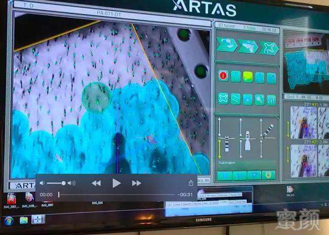 ARTAS机器人植发技术优势揭秘之二：提取均匀