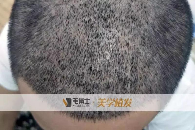 植发种完需要多长时间长出头发？这里讲的很详细
